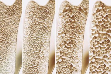 Osteoporose Stadien im Knochenquerschnitt
