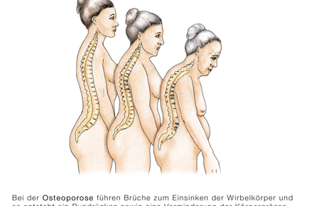 Einsinken der Wirbelkörper